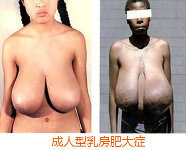 那些不易察觉的乳房疾病