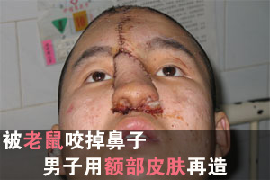 被老鼠咬掉鼻子 男子将用额头皮肤再造鼻头