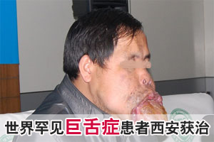 西安收治世界罕见“巨舌症”患者 