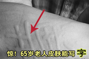 65岁女士皮肤能写字 医生疑是划痕症