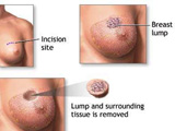 诱发乳腺癌的八大高危因素