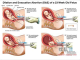 图解人流堕胎工具 吓人“杀人工具”