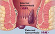 治疗痔疮 哪家医院治痔疮好