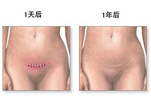 剖腹产产后恢复四重点
