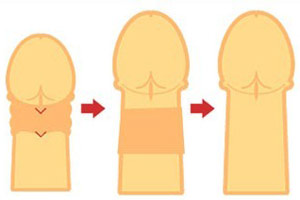 男人小“武器”延长方