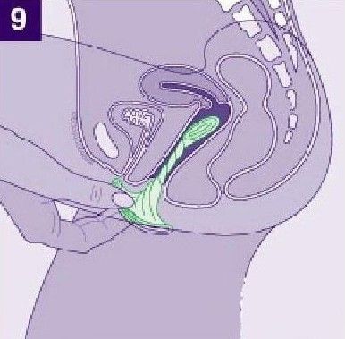 女用避孕套使用方法
