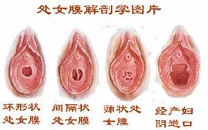 处女膜孔的直径约为1～1.5厘米