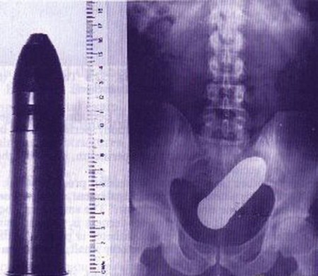匪夷所思X光片：遗落身体里的自慰品