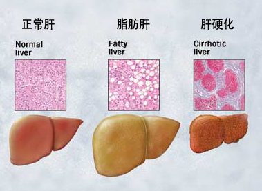 专家:肝硬化绝不是生命的终点站 专家:肝硬化绝不是生命的终点站