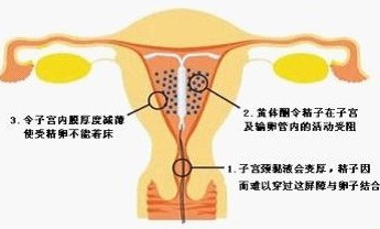 爆！女性上环全过程(多图）