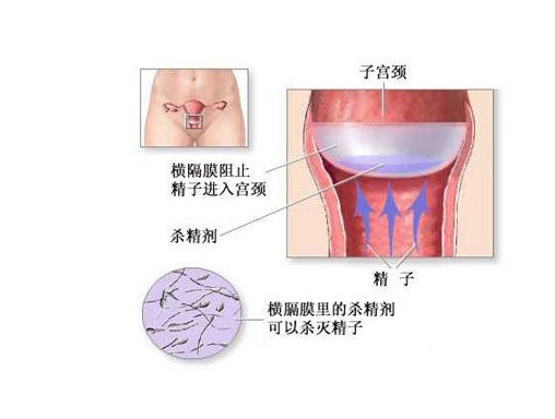 女人怎样避孕