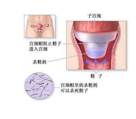 女人怎样避孕