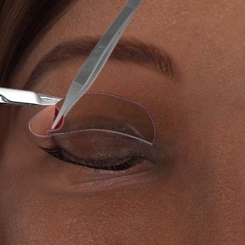 揭秘！双眼皮手术是怎么做的？