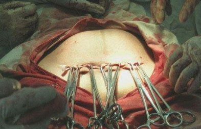 图解剖腹产手术全过程