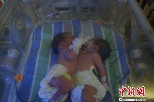 重庆医生跋涉300公里救助初生连体婴重庆医生跋涉300公里救助初生连体婴