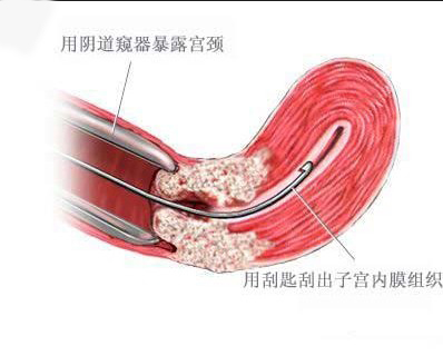 图解人流刮宫手术全过程