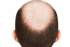 年轻脱发频发 如何避免?