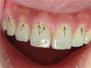 牙齿酸蚀症需注意预防