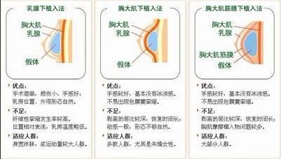 直击丰胸手术现场，带你了解隆胸