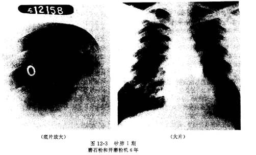 矽肺